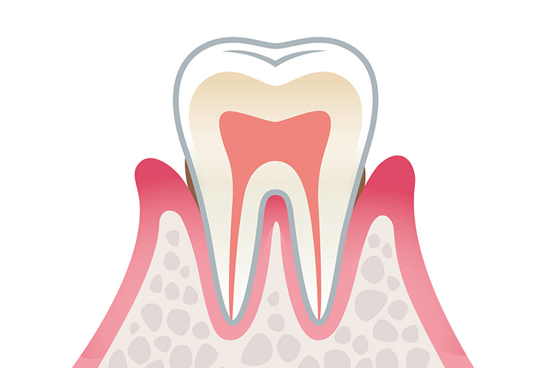 歯肉炎初期～中程度（進行度1）