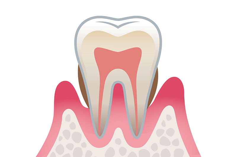 歯肉炎中程度～重症（進行度2）