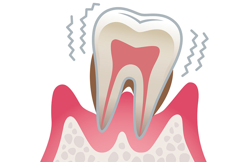 歯周炎重症（進行度3）